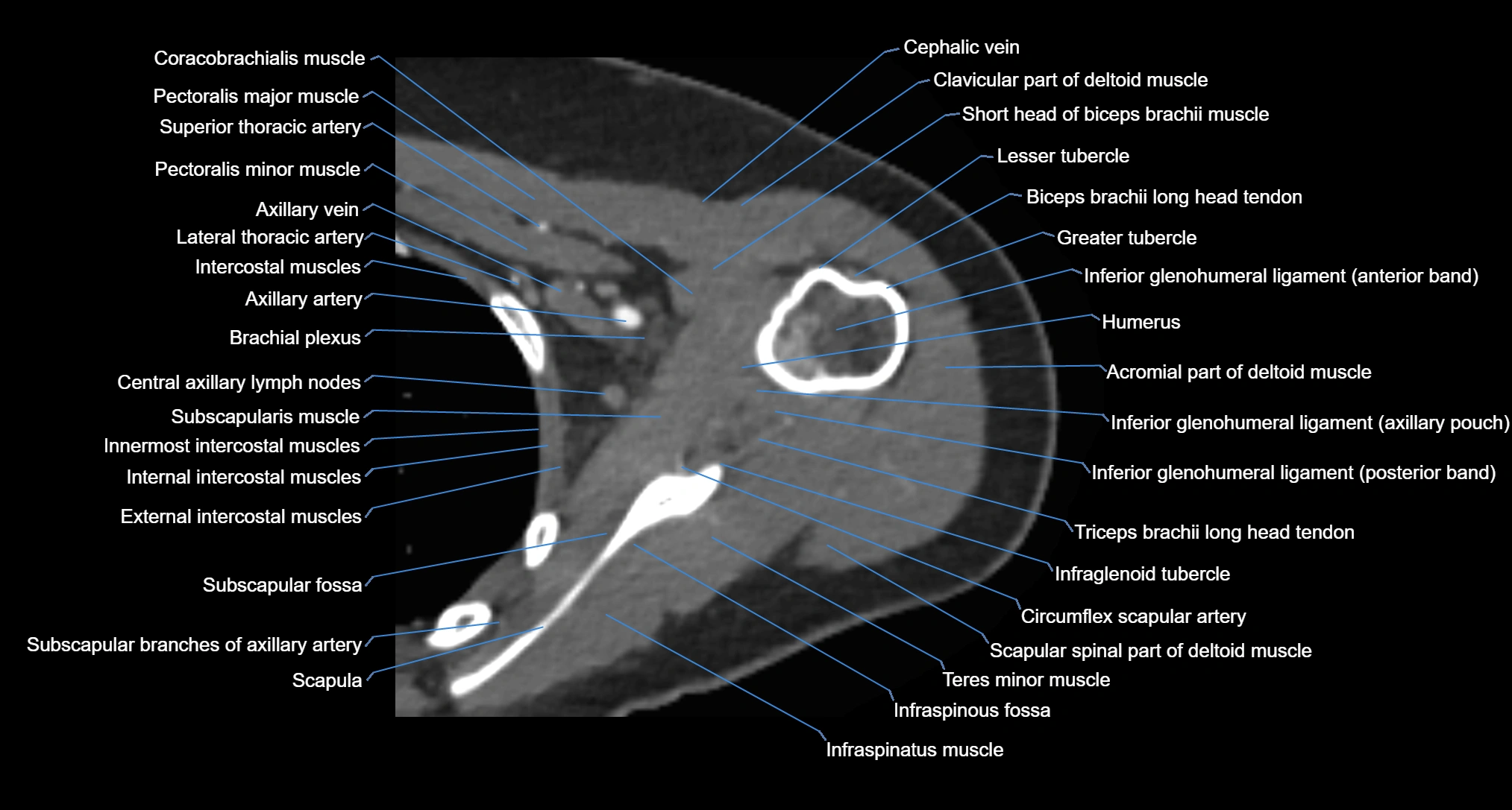 CT Shoulder axial cross sectional anatomy labelled radiology image -00041.webp